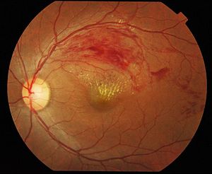 Branch_retinal_vein_occlusion