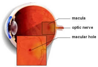 Macular-Hole