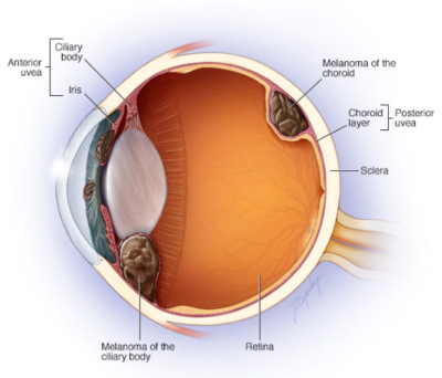 Ocular_Tumors